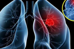 Sức khỏe đời sống - NSƯT Tiến Hợi qua đời vì ung thư phổi: 4 dấu hiệu dễ nhận biết nhất nhưng rất dễ bị bỏ qua