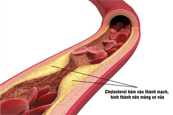 Hiểu đúng về Cholesterol để phòng bệnh mỡ máu cao - 1