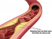 Sức khỏe đời sống - Hiểu đúng về Cholesterol để phòng bệnh mỡ máu cao