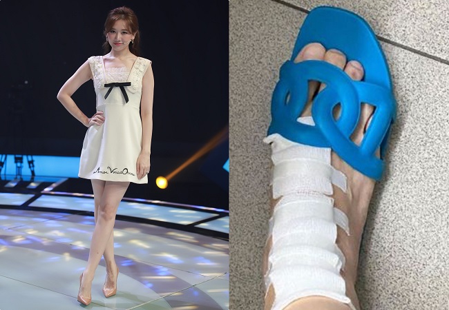 Tham gia một chương trình truyền hình, Hari Won diện váy ngắn, mang giày cao gót để lộ chân bị thương với vết sẹo chằng chịt. Trước đó, nữ ca sĩ cho biết cô bị trượt ngã khi đang ghi hình cho một chương trình truyền hình.
