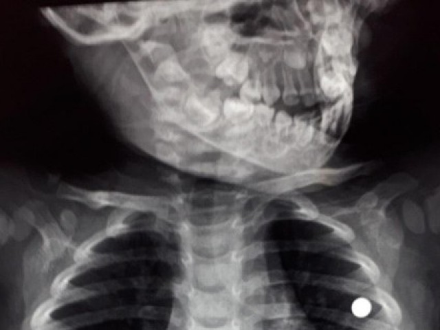 Sức khỏe đời sống - Thanh Hoá: Anh chơi đùa súng tự chế bắn thủng ngực em trai