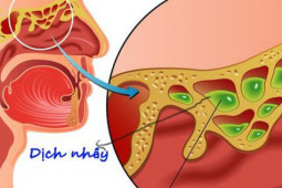 Sức khỏe đời sống - 8 biện pháp làm giảm ngạt mũi cho F0