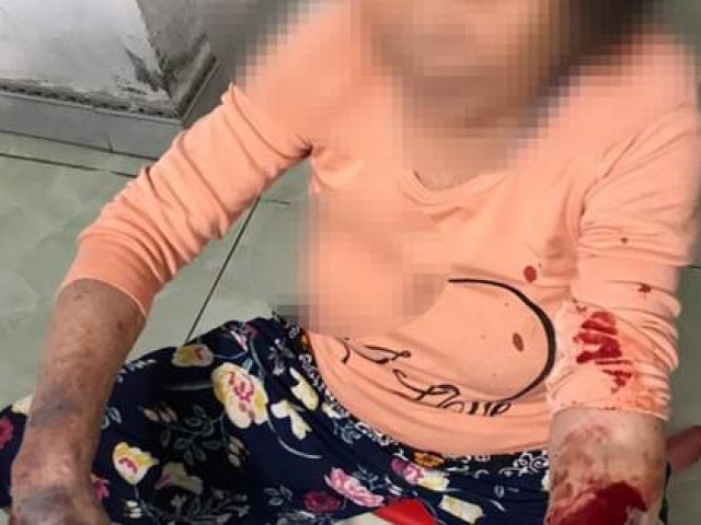 Pháp luật - Nhắc nhở hát karaoke ồn ào, cụ bà 83 tuổi đang là F0 bị đánh nhập viện