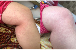 Sức khỏe đời sống - Sau COVID-19, trẻ có thể mắc hội chứng viêm đa hệ thống, bác sĩ cảnh báo dấu hiệu