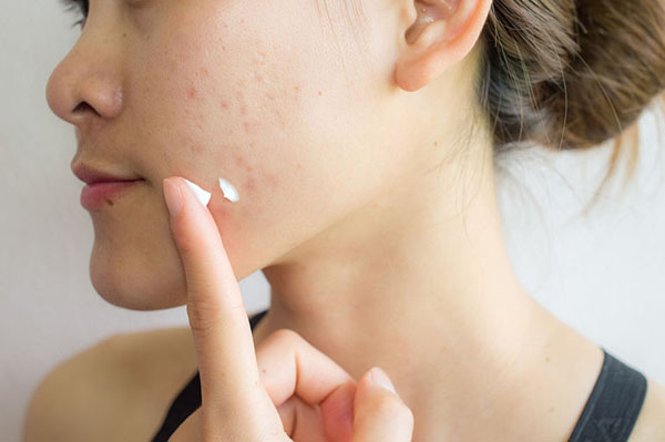 8 steps of skincare to help acne prone skin quickly, smooth, healthy and beautiful - 3