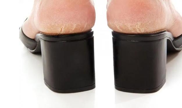 Gót chân nứt nẻ là một dấu hiệu cho thấy cơ thể bạn đang thiếu nước.