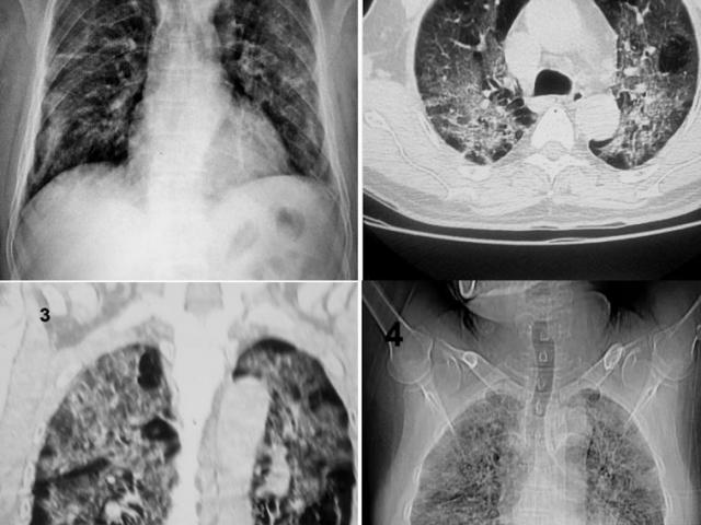 Sức khỏe đời sống - Chuyên gia cảnh báo: Đờm, ho, khó thở hậu Covid hiểm hoạ chớ coi thường