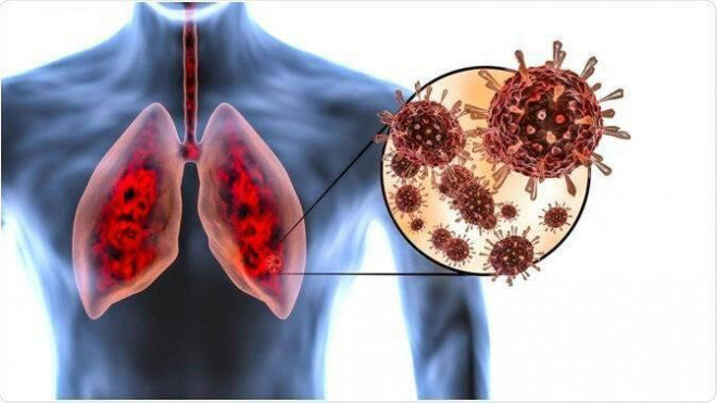 Khó thở dai dẳng là dấu hiệu tổn thương phổi ở bệnh nhân mắc COVID-19 - 3
