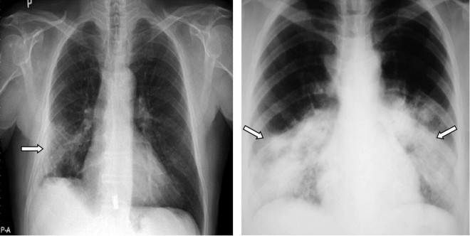 Khó thở dai dẳng là dấu hiệu tổn thương phổi ở bệnh nhân mắc COVID-19 - 4