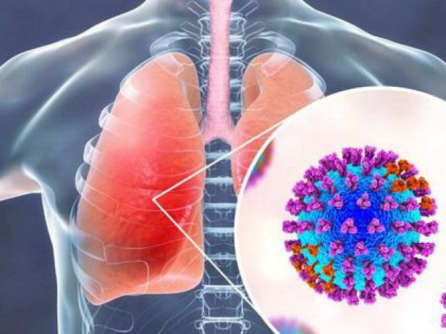 Sức khỏe đời sống - COVID-19 có thể gây tổn thương phổi kéo dài