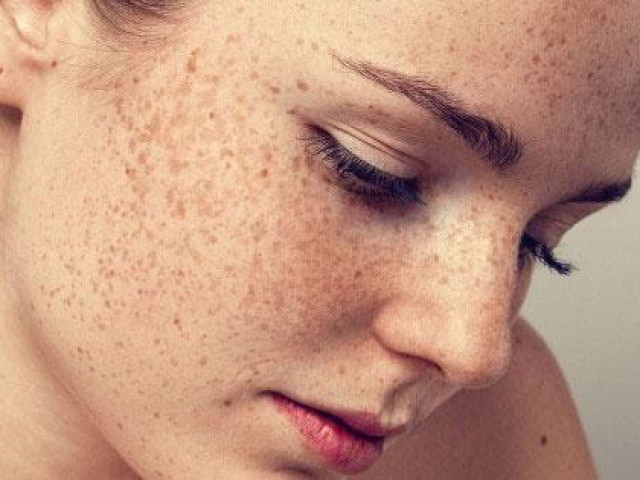 Những bộ phận trên cơ thể rất dễ bị ung thư da nhưng ít ai để ý