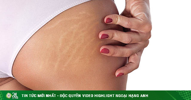 5 ways to reduce stretch marks very effectively with simple methods-Beauty