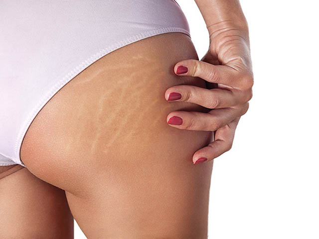 Làm đẹp - 5 cách giảm rạn cực hiệu quả bằng phương pháp đơn giản