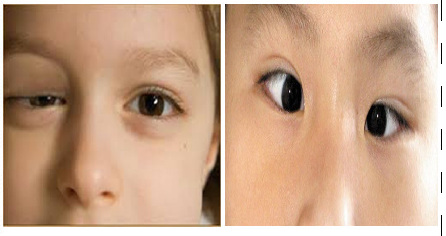 Bệnh sụp mí và mắt lác ở trẻ em