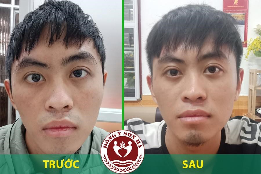 Bệnh sụp mí mắt, mắt lác ở trẻ em và cách điều trị an toàn bằng Đông y - 3