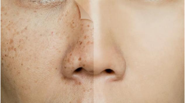 Mẹo giúp bạn khắc phục sắc tố da trên mặt - 3