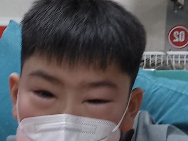 Sức khỏe đời sống - Bé trai phản vệ, mắt sưng húp sau khi ngậm một viên thuốc chữa ho