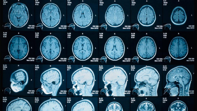 Hình ảnh não (được hiển thị) có thể tiết lộ khi một số vùng não phát triển hoặc thu nhỏ sau khi bệnh nhân bị mắc COVID-19