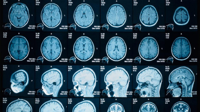 How does COVID-19 change our brains?  - first