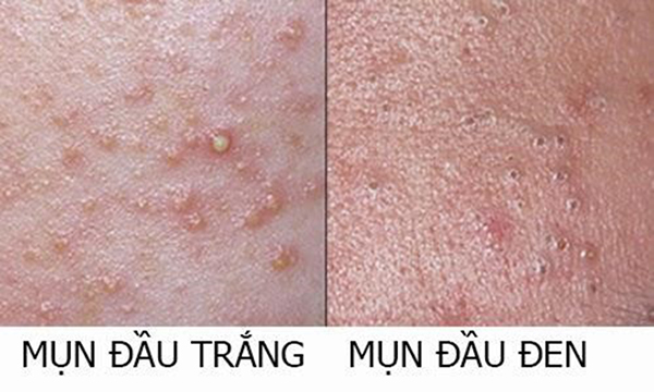 Dù không đau đớn nhưng mụn đầu đen và mụn đầu trắng lại gây mất thẩm mỹ