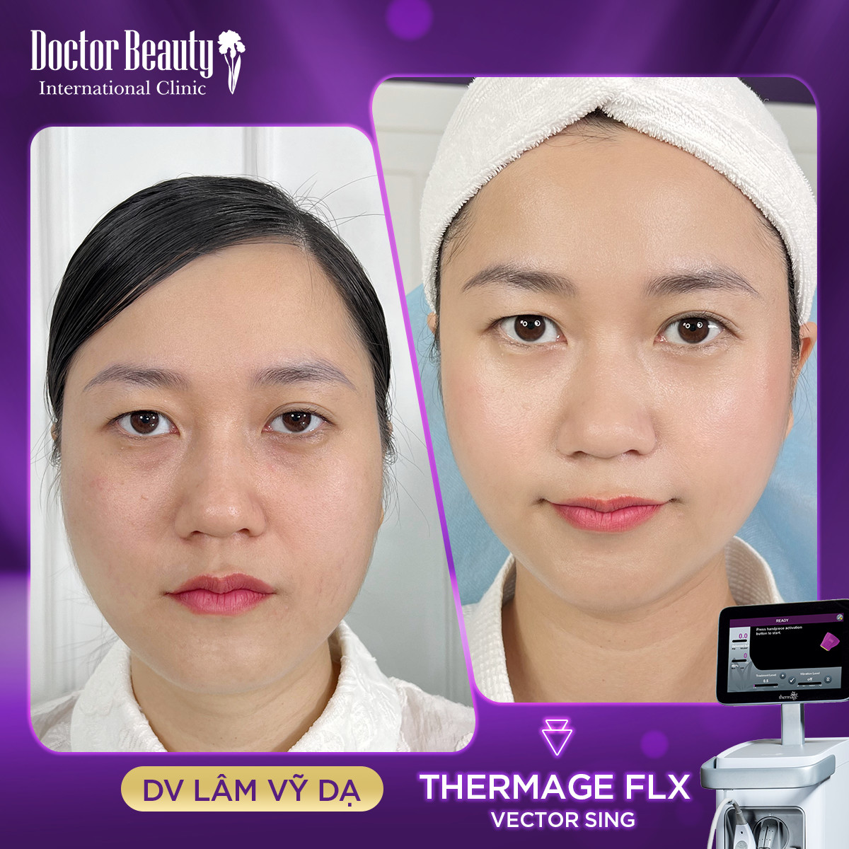 Doctor Beauty bật mí cách xóa nhăn cấp tốc của Lâm Vỹ Dạ - 3