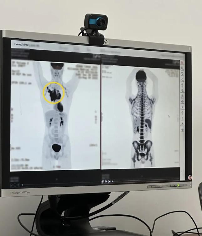 Qua hình ảnh chụp X-quang, các bác sỹ phát hiện ra khối u to bằng quả táo trong ngực Thomas Evans.