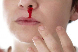 Sức khỏe đời sống - Nghẹt mũi, đau đầu kéo dài có thể là dấu hiệu bạn đã có khối u trong mũi