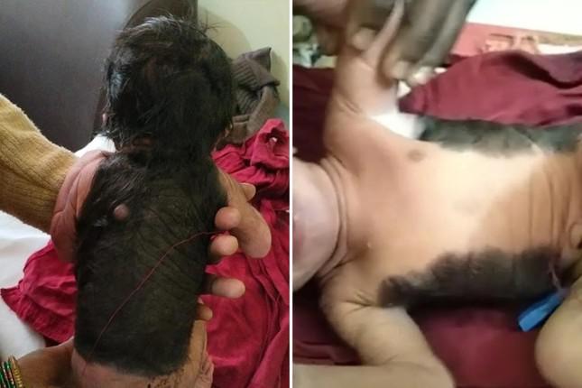 Lưng của cậu bé phủ kín lông và lông mọc trên 60% cơ thể.