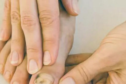 Sức khỏe đời sống - Phát hiện mắc ung thư nhờ điểm lạ ở ngón chân, chuyên gia cho biết người phụ nữ này "thật may mắn", dù đó là khối u ác tính