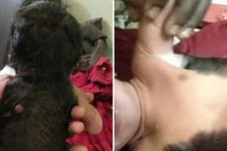 Kỳ lạ cậu bé sinh ra đã có lông, tóc khắp nửa người