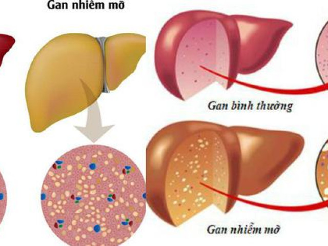 Gan nhiễm mỡ thường có 4 điểm chung này, chị em đừng nghĩ mình gầy mà chủ quan