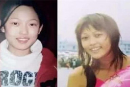 Bạn trẻ - Cuộc sống - Bé gái phẫu thuật mặt khi 14 tuổi, "đập đi xây lại" 300 lần giờ ra sao sau 17 năm?