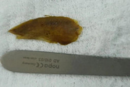 Sức khỏe đời sống - Thủ phạm trong mâm cơm khiến cụ bà bị thủng ruột