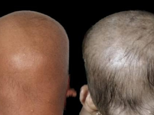 Sức khỏe đời sống - Bé gái 11 tuổi ở Bình Phước mắc bệnh hiếm gặp trên thế giới