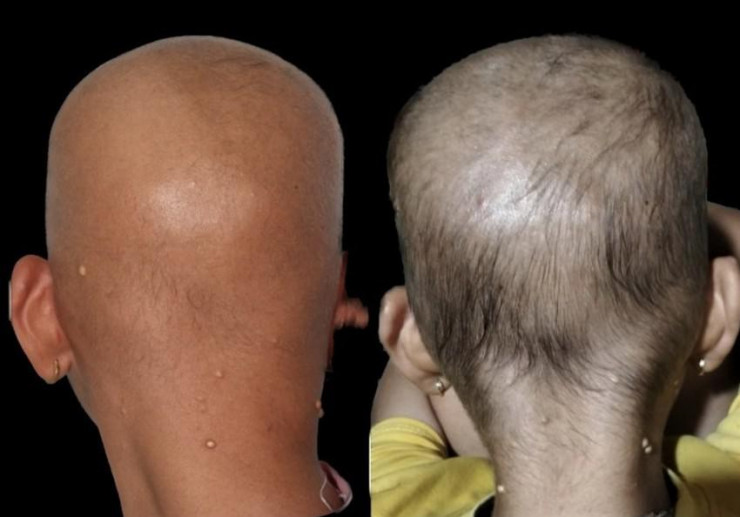 Hình ảnh ca bệnh trước và sau khi điều trị. Ảnh: BVCC