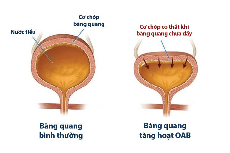 Bàng quang tăng hoạt là nguyên nhân phổ biến gây tiểu đêm