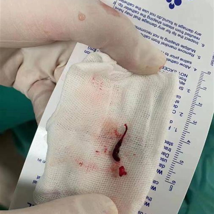 Huyết khối được lấy ra trong quá trình phẫu thuật (ảnh do Bệnh viện Puren Vũ Hán cung cấp)