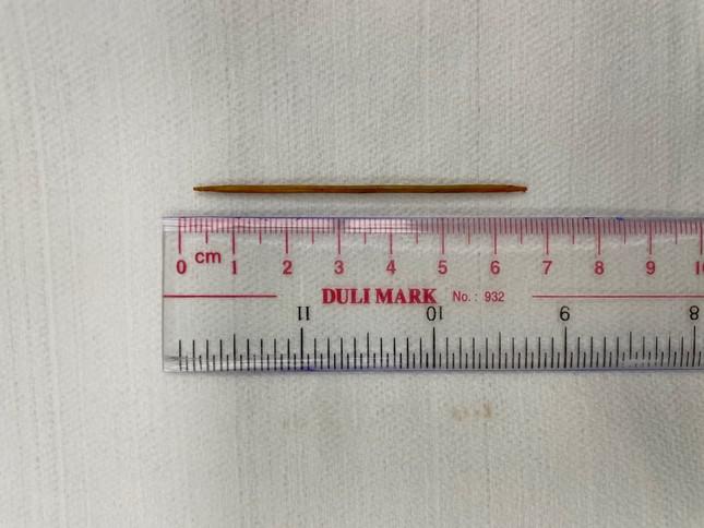 Chiếc tăm tre được lấy ra khỏi cơ thể bệnh nhân.