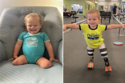 Bạn trẻ - Cuộc sống - Video cảm động cậu trẻ cụt chân lần đầu tiên bước đi trên chân giả