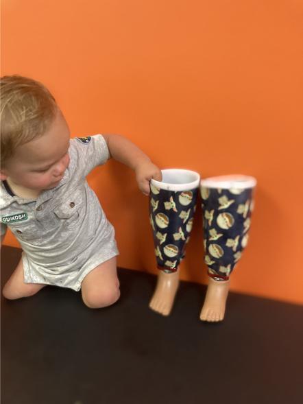 Video cảm động cậu trẻ cụt chân lần đầu tiên bước đi trên chân giả - 15