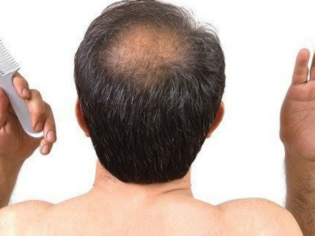 Sức khỏe đời sống - Rụng tóc, béo phì và đái tháo đường ở nam giới có cùng một "thủ phạm"?