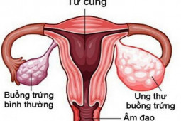 10 dấu hiệu khiến bạn nghĩ ngay đến ung thư buồng trứng