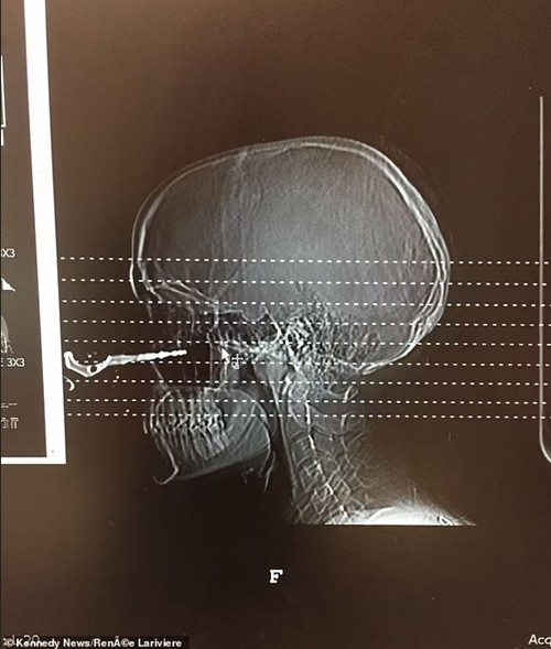 Phim chụp cho thấy chìa khóa ghim vào khoang mũi của Renée. Ảnh: Renée Lariviere.
