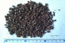 Sức khỏe đời sống - Bác sĩ lấy ra 420 viên sỏi trong thận người đàn ông, chỉ vì anh ta ăn món này trong nhiều năm