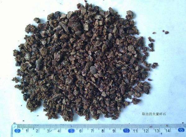 Bác sĩ lấy ra 420 viên sỏi trong thận người đàn ông, chỉ vì anh ta ăn món này trong nhiều năm - 2
