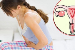 Sức khỏe đời sống - Dấu hiệu nhận biết u xơ tử cung, chị em cần biết để đi khám ngay