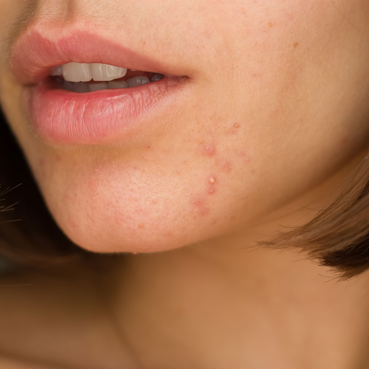 Muốn trị dứt mụn, bạn cần tuyệt đối tránh điều này - 1