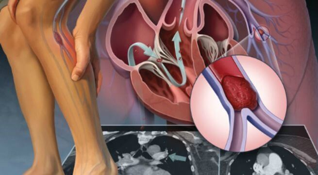 Biến chứng của suy giãn tĩnh mạch có thể gây nguy hiểm cho người bệnh (Ảnh minh họa)