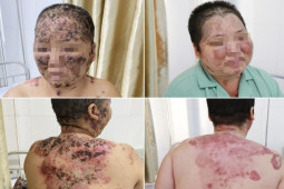 Sức khỏe đời sống - Chữa bệnh bằng lá cây, người phụ nữ bị lở loét, nguy kịch