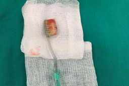 Sức khỏe đời sống - Nam thanh niên bị mắc kẹt bàn chải đánh răng trong thục quản vì lý do bất ngờ
